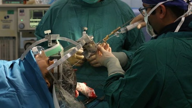 حذف تومور‌های مغزی با استفاده از دستگاه نوروناویگیشن ساخت متخصصان ایرانی برای اولین بار در مشهد