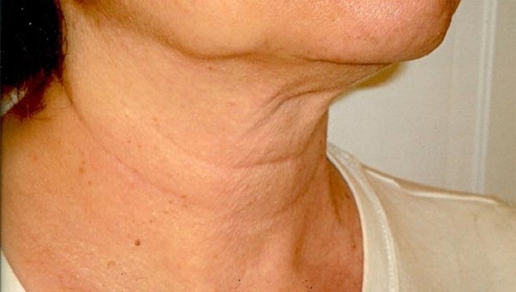 درمان افتادگی پوست صورت با چند روش ساده