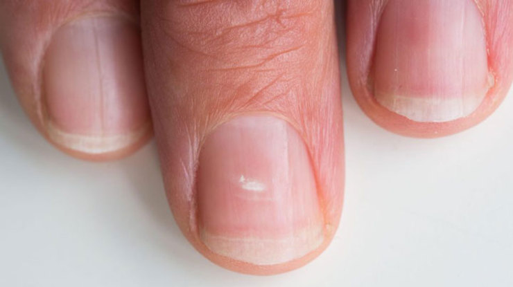 چرا روی ناخن لکه‌های سفید ایجاد می‌شود؟