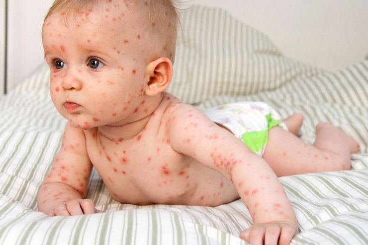 شیوع بیماری سرخک در کشور | واکسیناسیون کودکان را جدی بگیرید