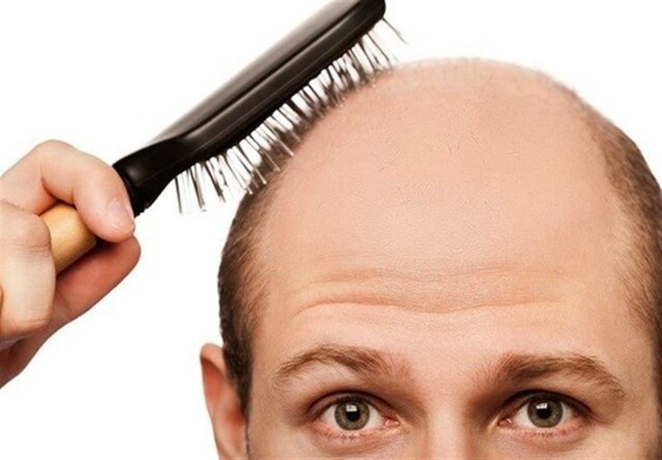 بهترین درمان ریزش مو با پیاز+ طرزتهیه چند ماسک مو