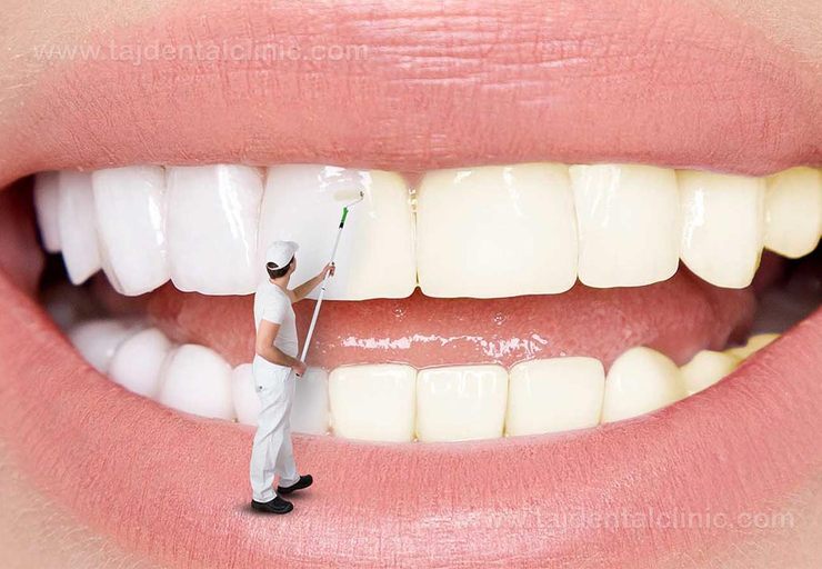 از آثار مخرب سفید کردن دندان چه میدانید؟