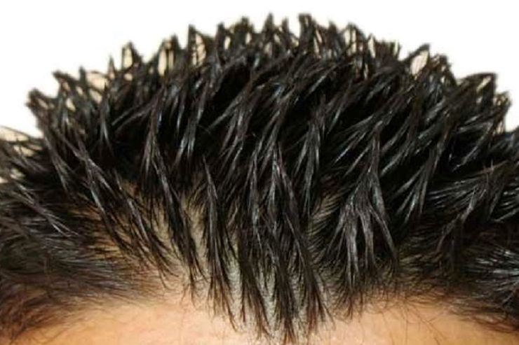 علل چرب شدن موی سر + راهکار‌های درمان آن