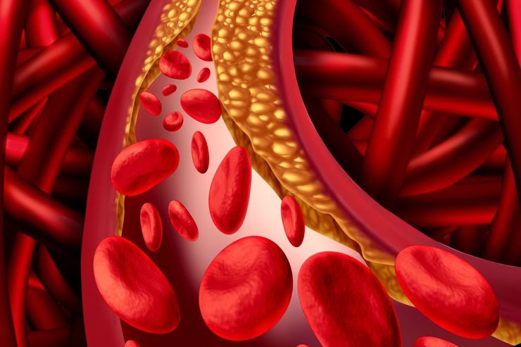 ۱۰ مورد از علائم و نشانه‌های فرد مبتلا به چربی خون