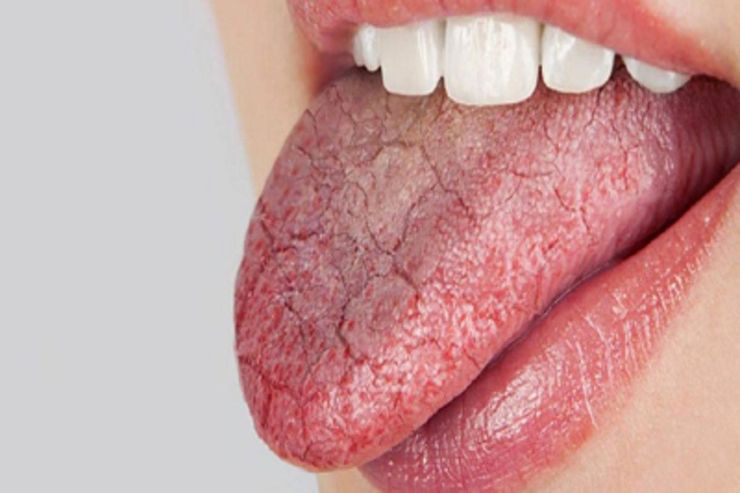 ۱۳ علت خشکی دهان که از آن‌ها بی‌خبرید!