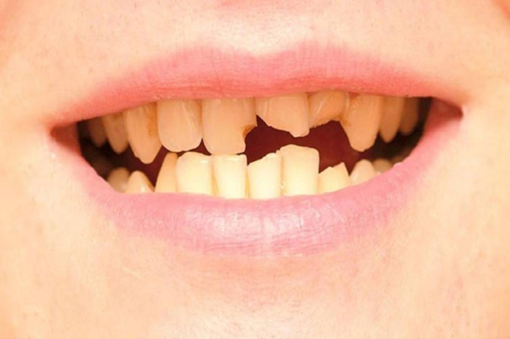 ترک خوردگی و شکستگی دندان را با این ۸ روش درمان کنید