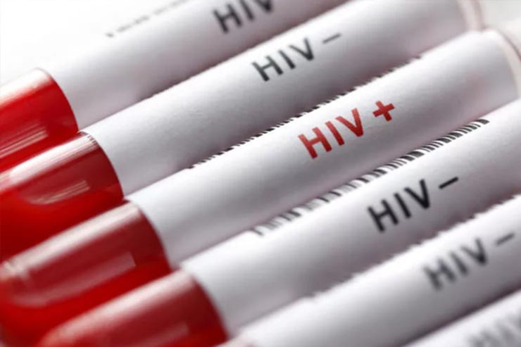 ابتلا به HIV ، میزان مرگ و میر کرونا را افزایش می دهد؟