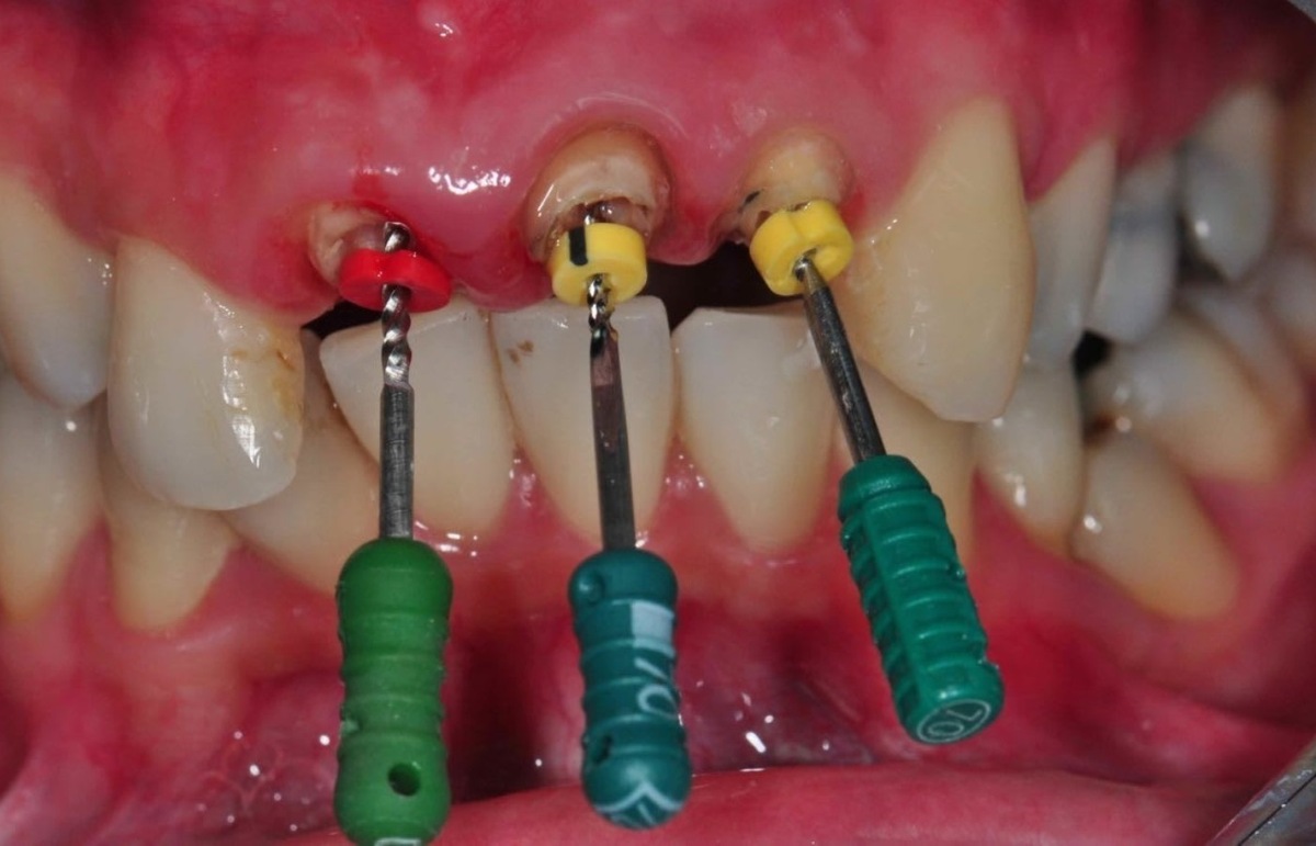 ویدئو| عصب‌کشی دندان