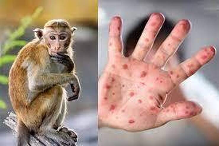 هشدار رئیس جامعه پزشکان داخلی ایران درباره آبله میمونی؛ آبله میمونی به آنفلوآنزا شباهت دارد