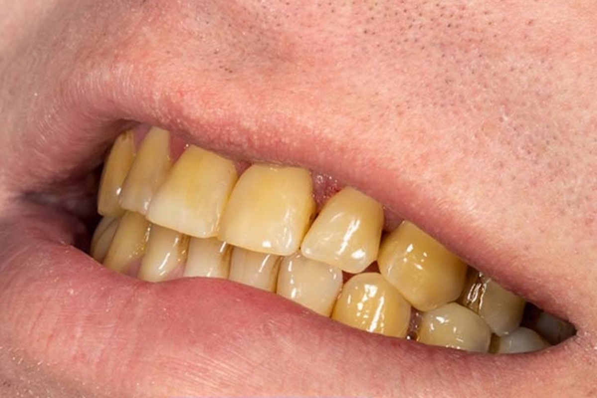 اینفوگرافی| پنج اشتباه رایجی که باعث زردی دندان‌ها می‌شود