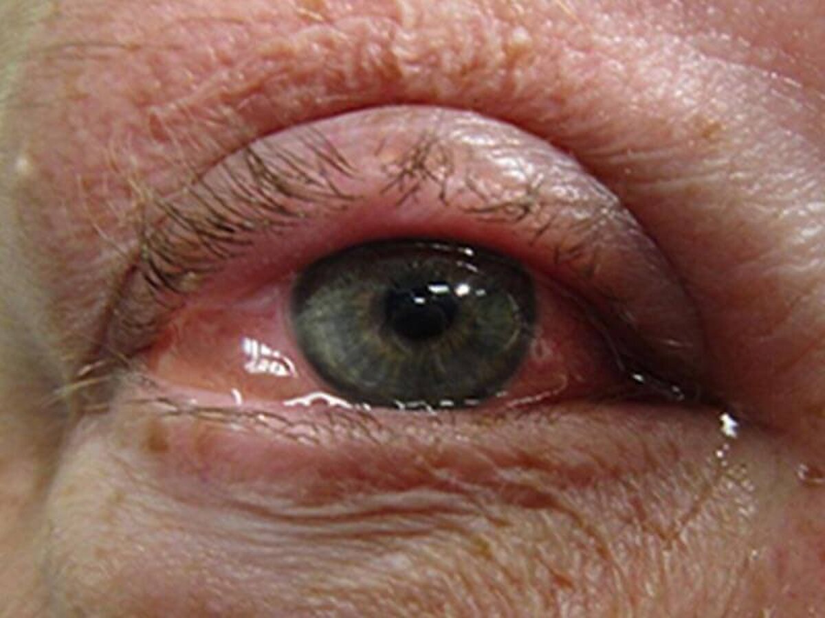 با التهاب چشم، ناشی از حساسیت چه کنیم؟